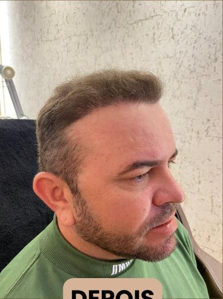Depois do transplante capilar